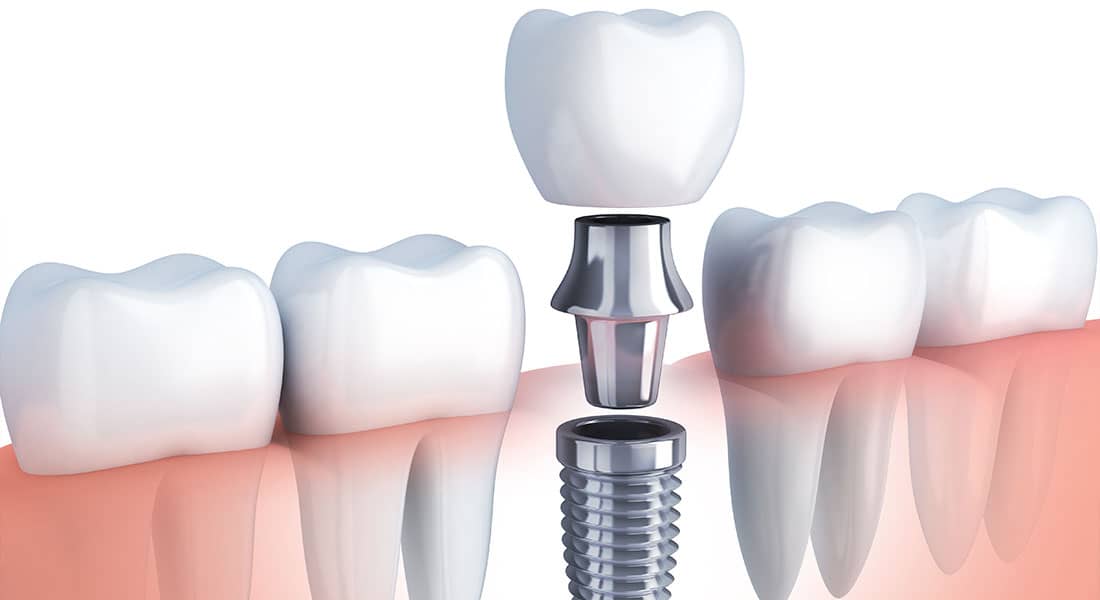 Implante Dentário